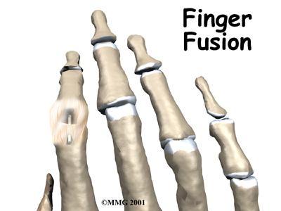 Finger Fusion Surgery - Eastwood Physiotherapy's Guide