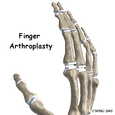Artificial Joint Replacement of the Finger - Eastwood Physiotherapy's Guide